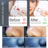 Hydra Dermabrasion Aqua Peeling Beauty Device: Unleash Your Skin's Radiance